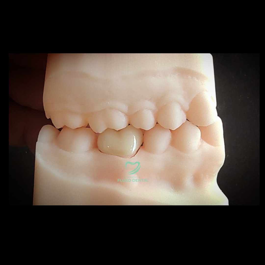 Coroa E-max Posterior